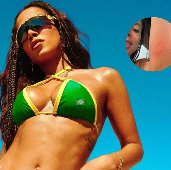 Anitta fue picada por una medusa y mostró sus impactantes quemaduras