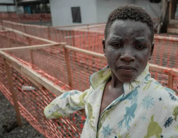 Más de 18.700 casos de mpox en África desde principios de año