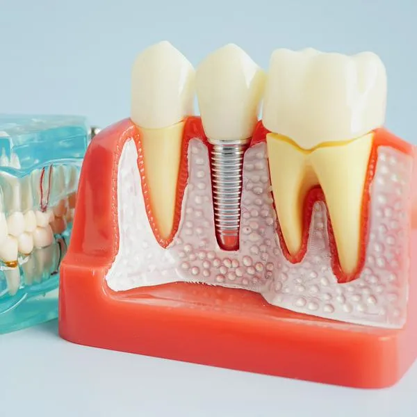 Todo lo que debes saber sobre los implantes dentales