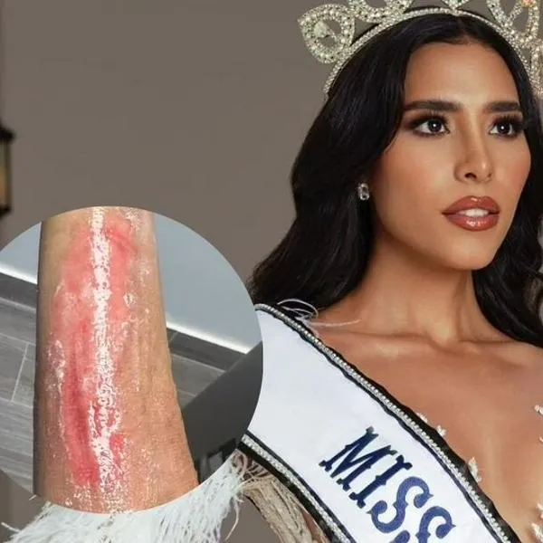 Video | A exreina de belleza le explotó una olla de presión y causó graves quemaduras