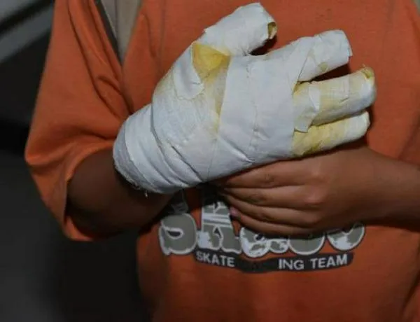 Tolima: joven lucha con quemaduras en su mano luego de que un amigo le lanzara un tote 