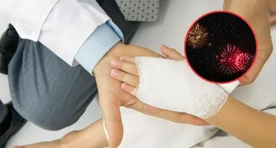 Mano de un niño quemado con pólvora, para referenciar el accidente de un menor en Melgar con estos artefactos