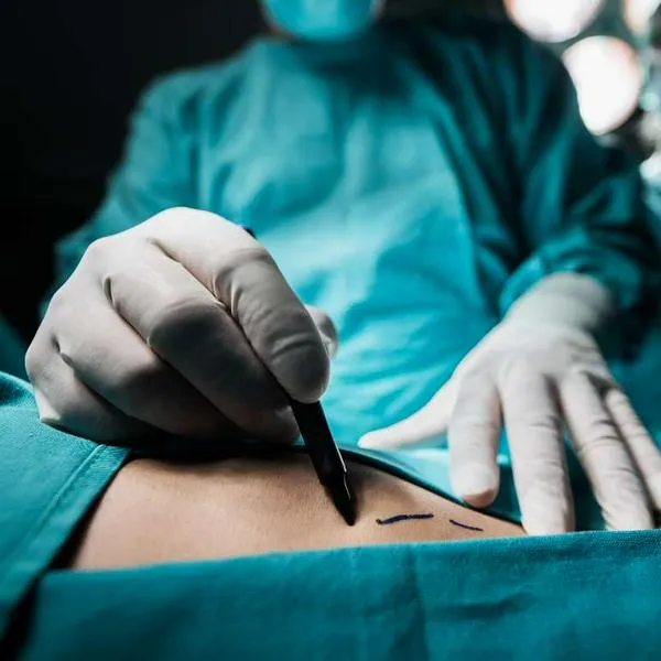 Foto de cirugpia, en nota de condena a peluquera en Colombia, sin formación, por liposucción a mujer, que murió