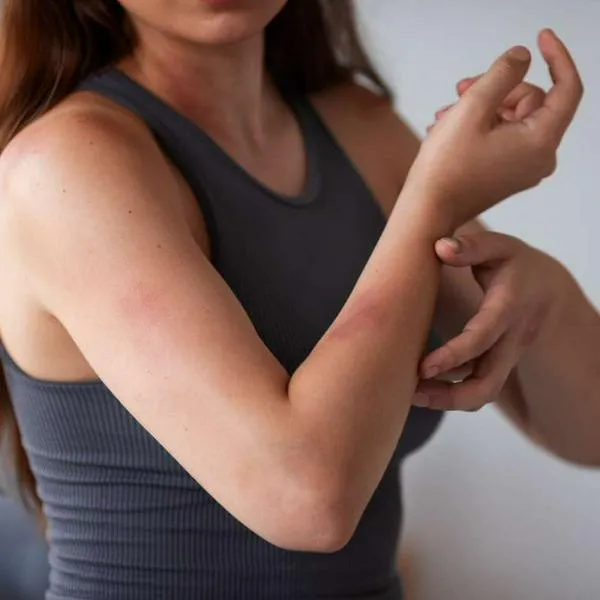 Foto de dermatitis atópica, en nota de qué es dermatitis atópica, enfermedad con pacientes en Colombia y duros efectos