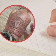 Mujer ignoró una cortada con papel y casi pierde la mano: terminó en urgencias