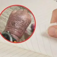 Mujer ignoró una cortada con papel y casi pierde la mano: terminó en urgencias