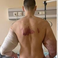 Influencer que se deformó los bíceps podría perder ambos brazos