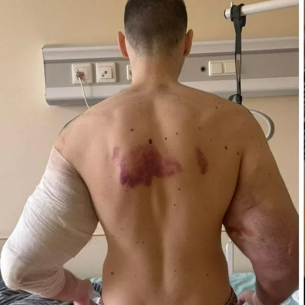 Influencer que se deformó los bíceps podría perder ambos brazos