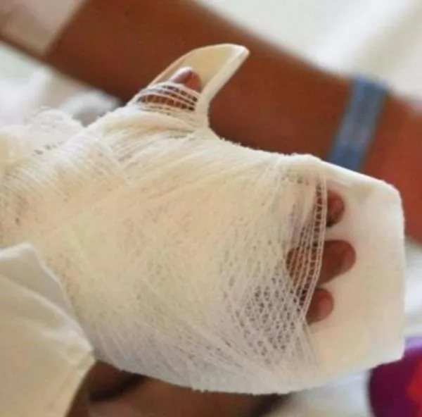 Cuántos quemados con pólvora se registraron por Día de Velitas 7 de diciembre