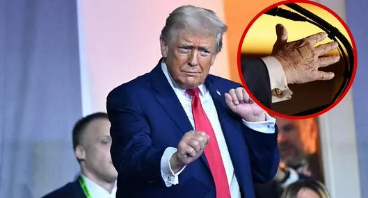 Qué pasó con las manos de Donald Trump: vendajes del presidente de EE. UU