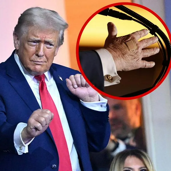 Qué pasó con las manos de Donald Trump: vendajes del presidente de EE. UU