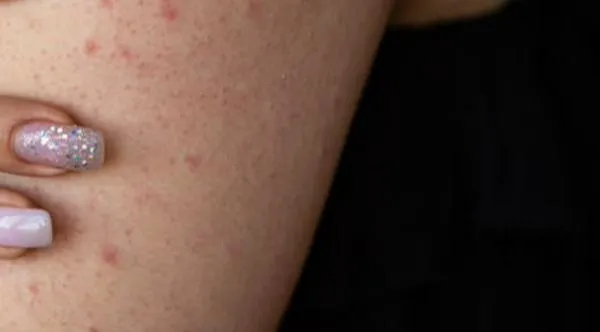 Explicando qué es la queratosis: Ojo a síntomas y opciones de tratamiento