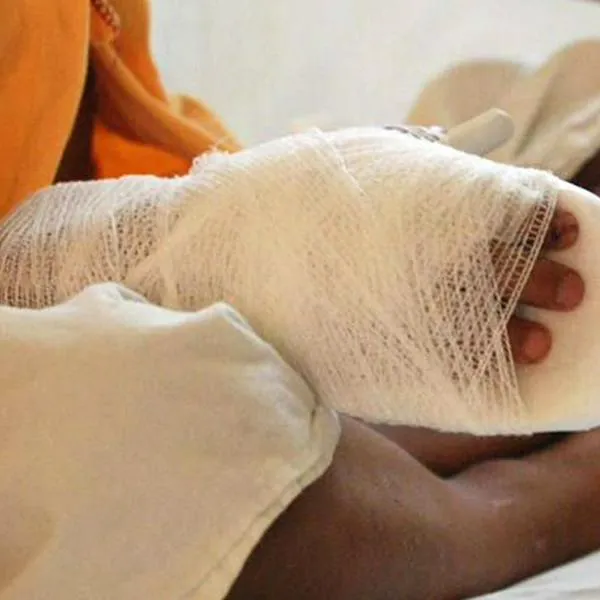 Aumentan los quemados con pólvora en el Valle del Cauca: autoridades en alerta