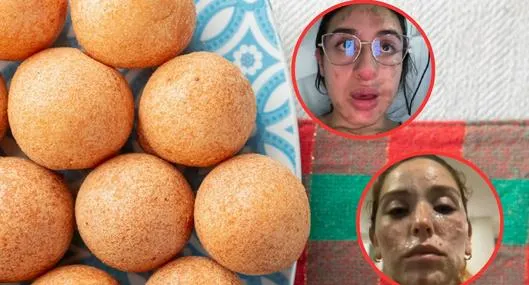 Jóvenes en Bogotá se queman la cara haciendo buñuelos: contaron sus casos
