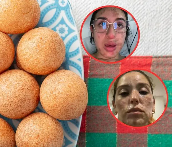 Jóvenes en Bogotá se queman la cara haciendo buñuelos: contaron sus casos