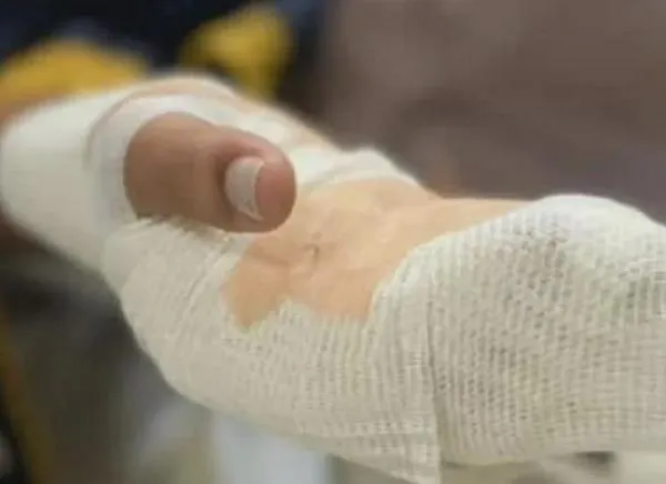 Ibagué en alerta por quemaduras en las noches del 24 y 31 de diciembre