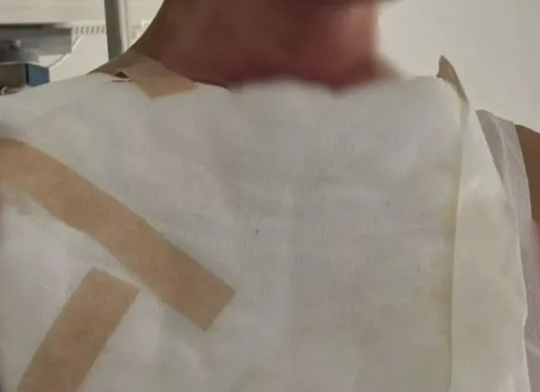 Continúan aumentando los quemados por pólvora en Ibagué