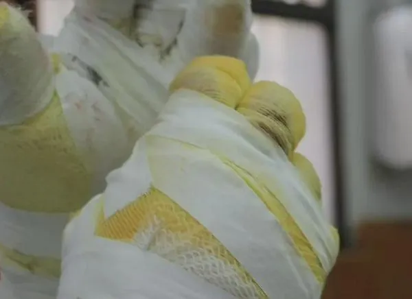 Ascienden a 800 los quemados en este diciembre en Colombia 