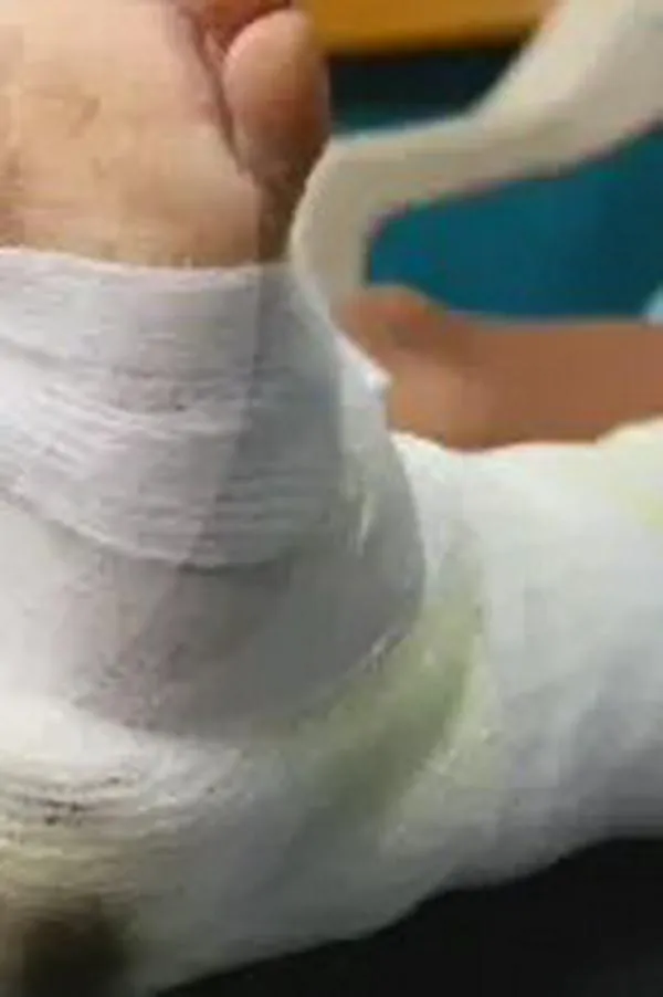 Lo que faltaba: quemaduras por líquidos calientes tienen saturados los servicios hospitalarios en Antioquia