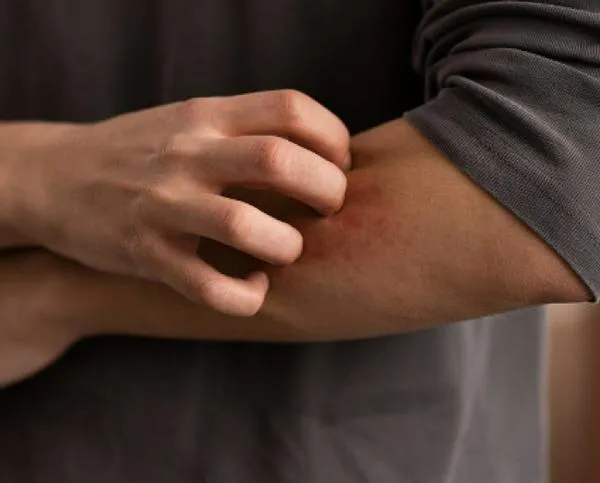 ¡Precauciones necesarias!: cómo evitar picaduras de insectos en sus vacaciones