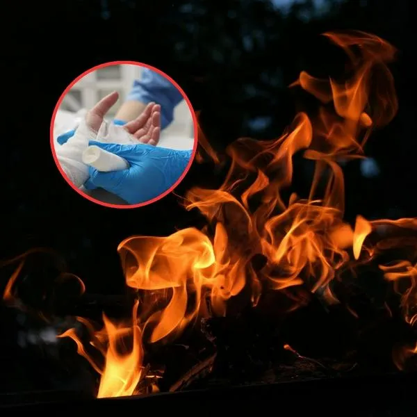 Niño de 8 años está en UCI: tuvo graves quemaduras por jugar con gasolina