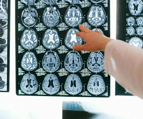 Un ataque cerebrovascular puede ser mortal: Así puede identificarlo y actuar a tiempo