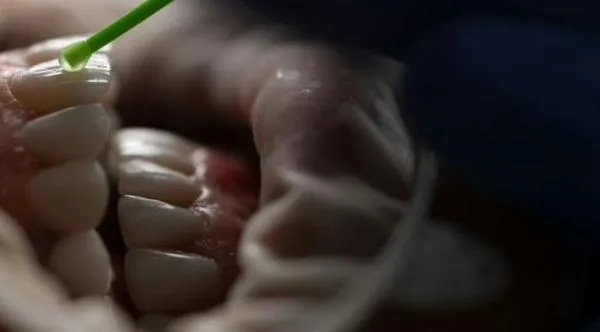 ¿Las carillas son buenas para los dientes o les hacen daño? Experta aclara duda