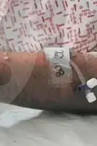 Confirman primer caso de viruela símica en Barrancabermeja (Santander); activan cerco epidemiológico