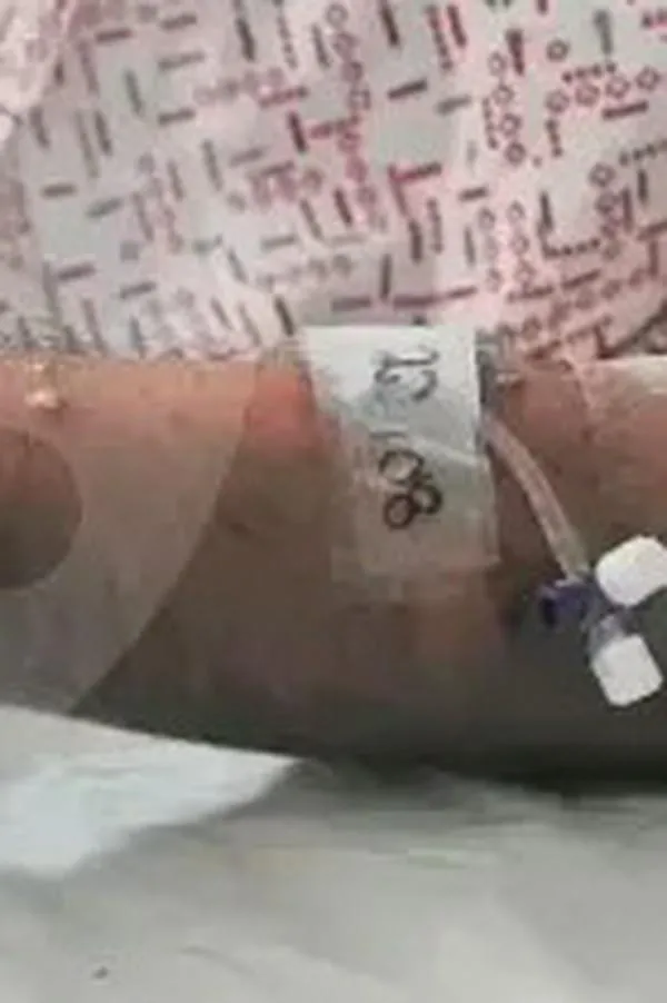 Confirman primer caso de viruela símica en Barrancabermeja (Santander); activan cerco epidemiológico