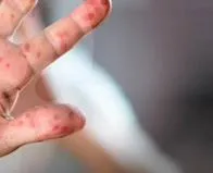 ¿Qué es el sarampión, cuáles son sus síntomas y qué se hace en el país para prevenir un brote?