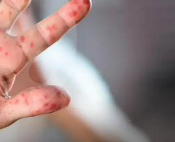 ¿Qué es el sarampión, cuáles son sus síntomas y qué se hace en el país para prevenir un brote?