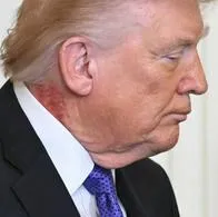 Donald Trump, presidente de Estados Unidos, con una mancha roja en el cuello