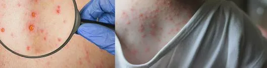 Aíslan a 18 estudiantes por brote de varicela en colegio de Aguachica