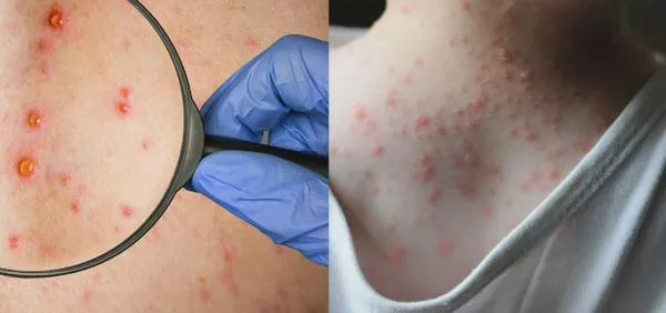 Secretaría de Salud tomó fuertes medidas tras brote de varicela en colegio de Aguachica