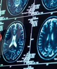 ¿No recuerda sus sueños? Podría ser un síntoma precoz de Alzheimer, dicen expertos