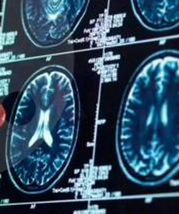 ¿No recuerda sus sueños? Podría ser un síntoma precoz de Alzheimer, dicen expertos