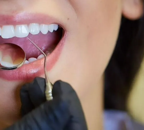 Caries dental, enfermedad frecuente que puede prevenirse