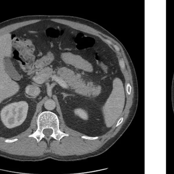 Tecnología contra el cáncer: IA, vacunas y armas moleculares