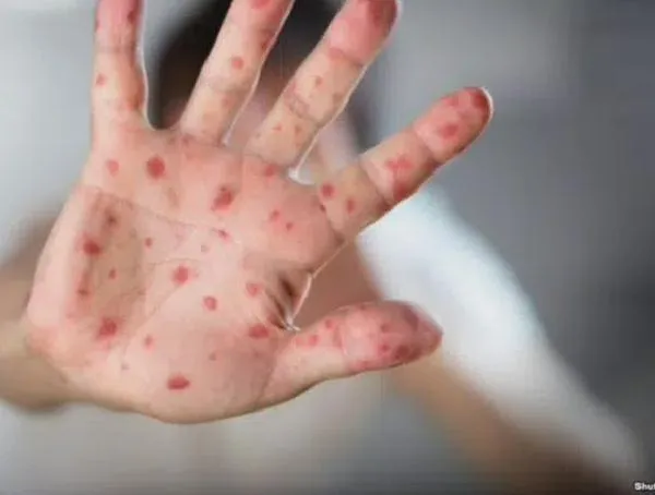 MiniSalud registró 15 casos de sarampión en el Amazonas y refuerza llamado a vacunarse