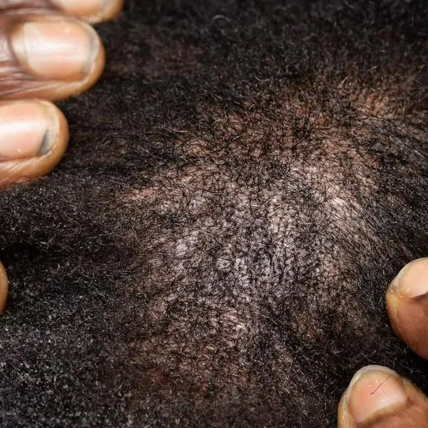 Alopecia androgenética: por qué ocurre la caída del cabello y cuáles son sus tratamientos