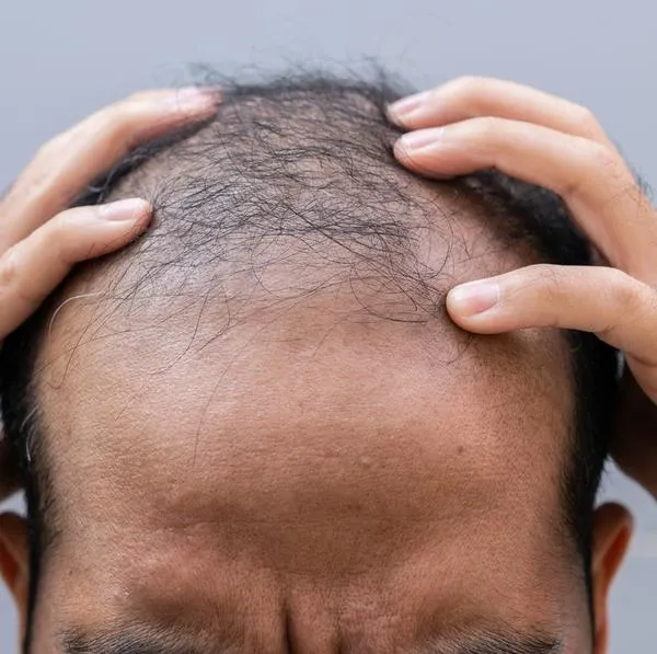 Hombre con poco cabello