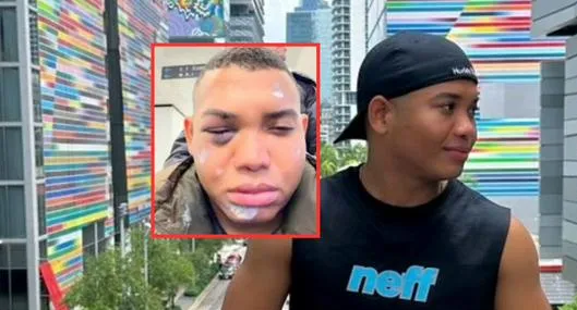 Polo Polo contó qué hay detrás de fotos en las que aparece golpeado: “Pude perder el ojo”